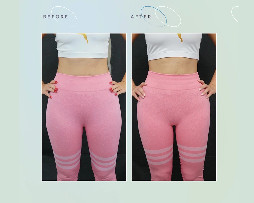 Buttock Augmentation Surgery Brazilian Butt Lift