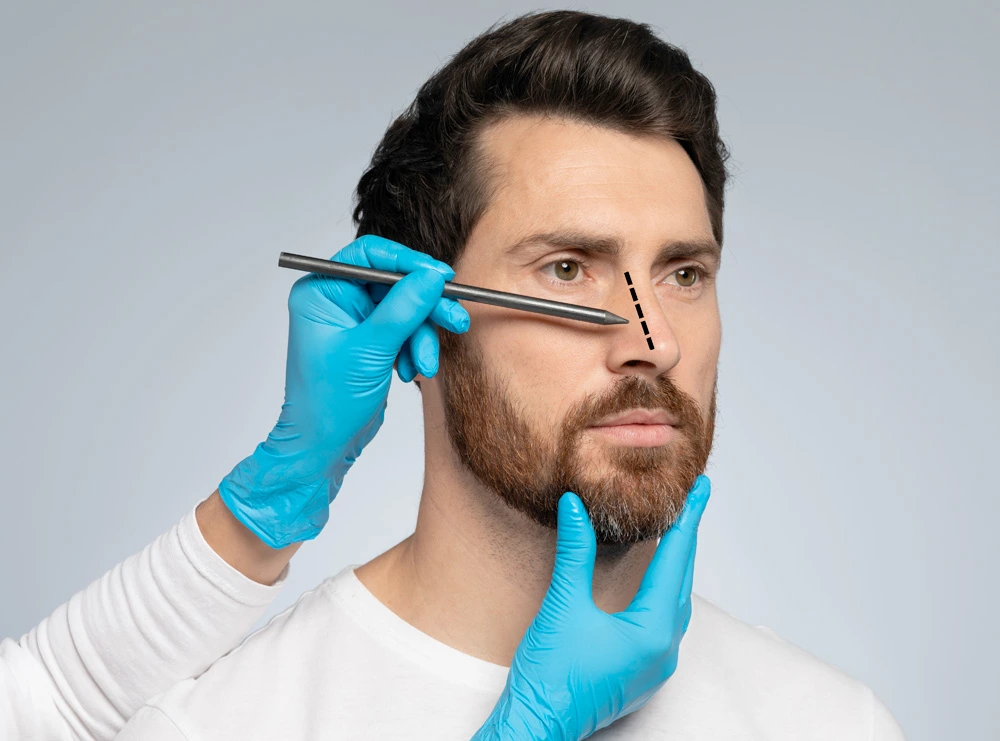 The Dual Benefits of Rhinoplasty for Broken Noses