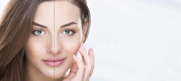 How To Get Rid of Acne
