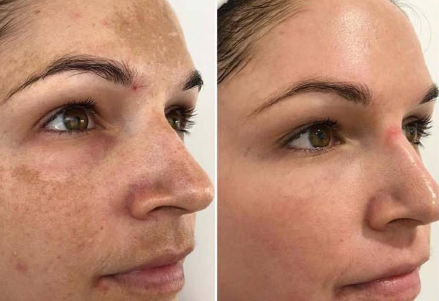 How to Effectively Treat Dark Spots on Your Face and Body