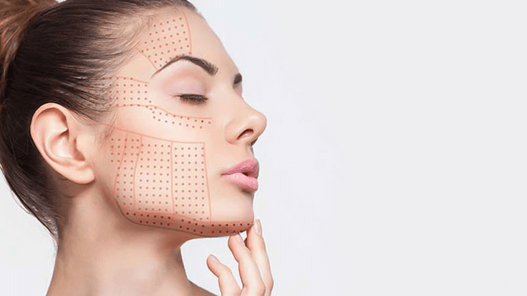 Thread Lifts: What to Expect, Benefits, and Risks