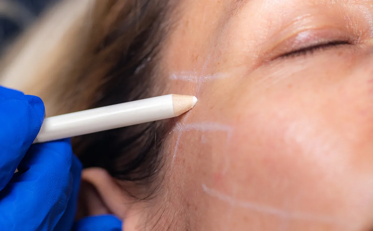 Face Threadlift