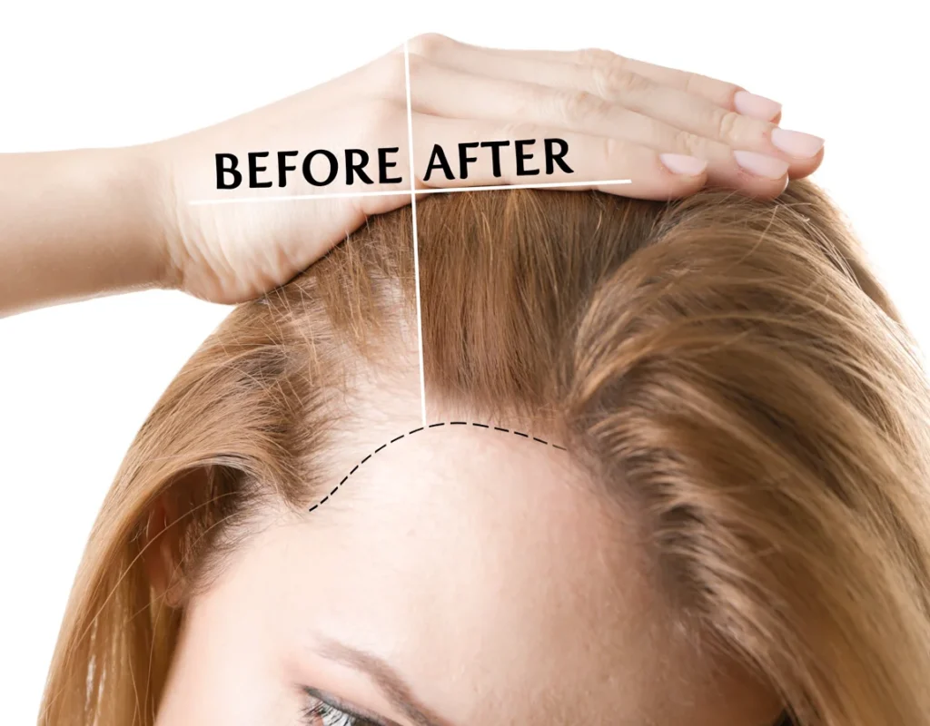 Hair Transplant in Dubai