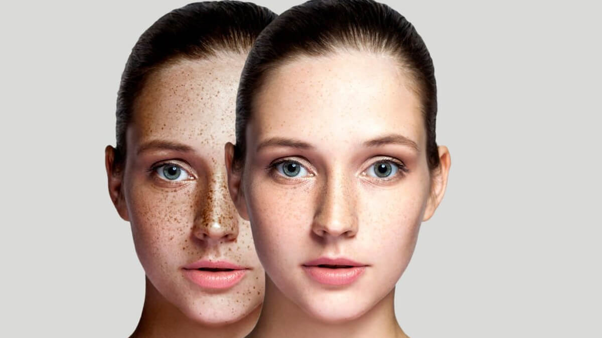 Causes Of Freckles & How To Remove Them?