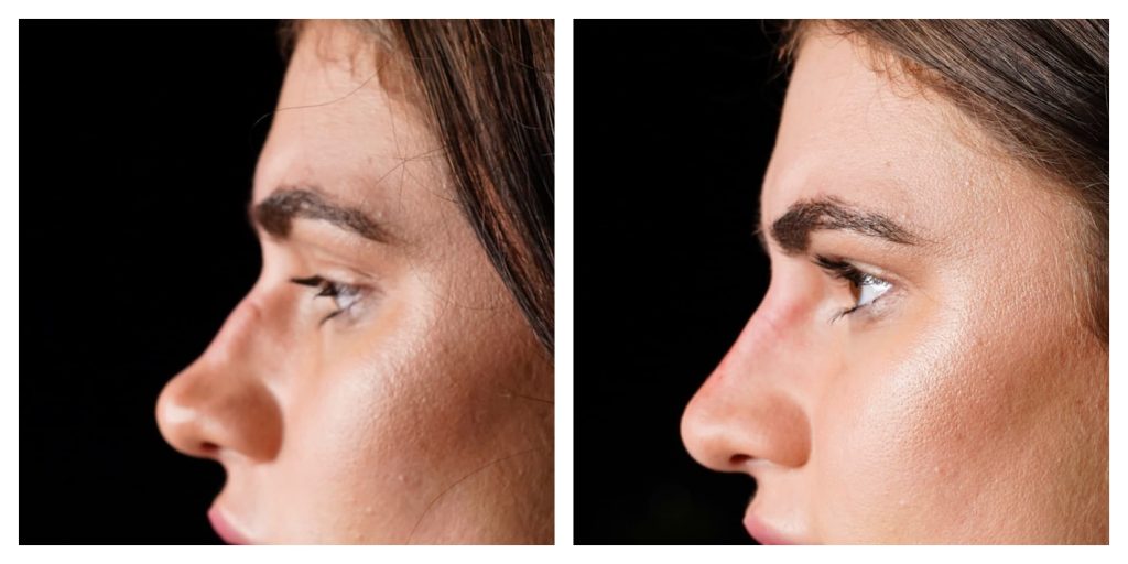 Non-surgical Rhinoplasty: A Non-Invasive Solution for Correcting Nasal Imperfections