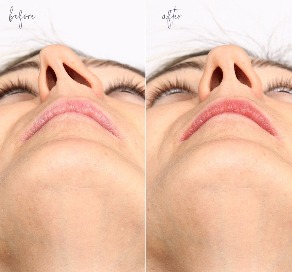Rhinoplasty