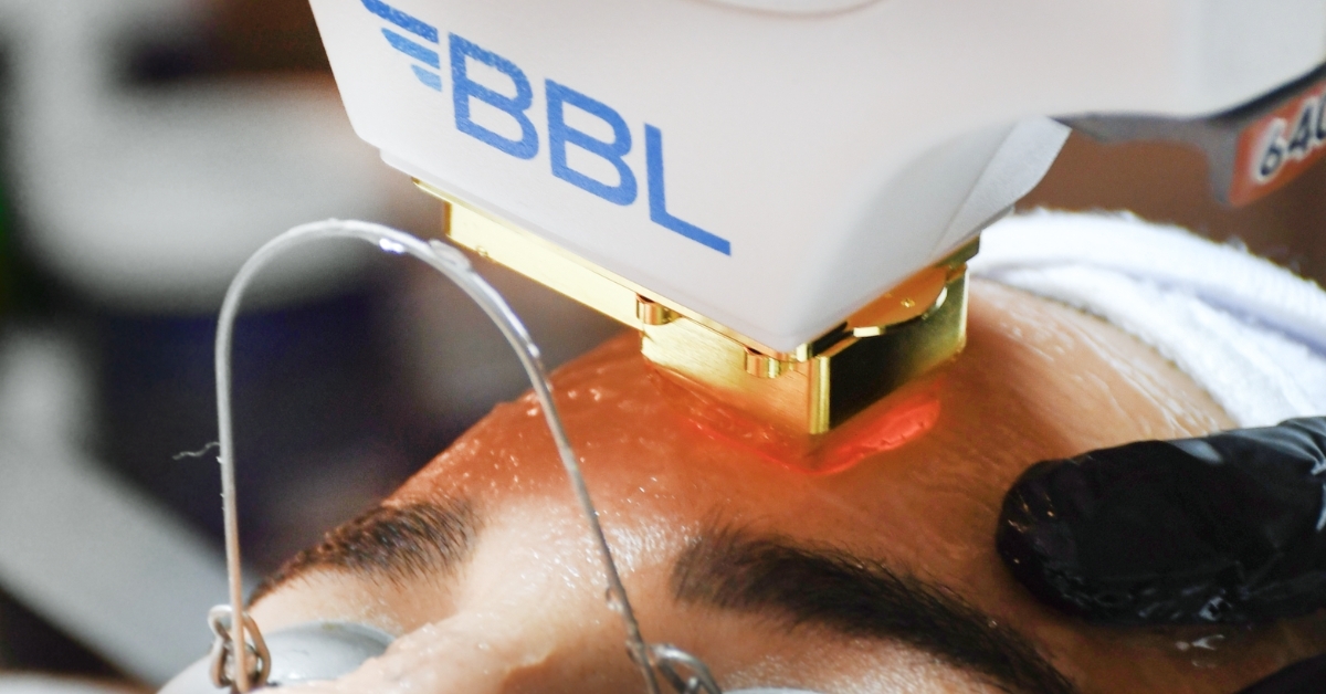 Everything You Need to Know About BBL (Broadband Light) for Acne