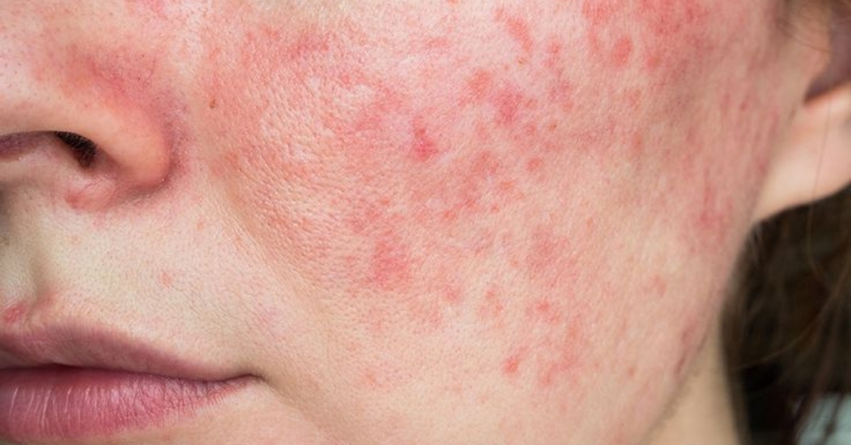 Comprehensive Review: Five Best Treatments for Rosacea