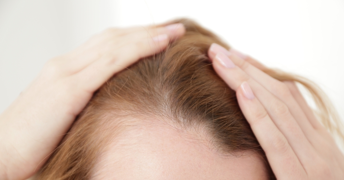 How to Prevent Hair Loss in Dubai with Innovative Treatments