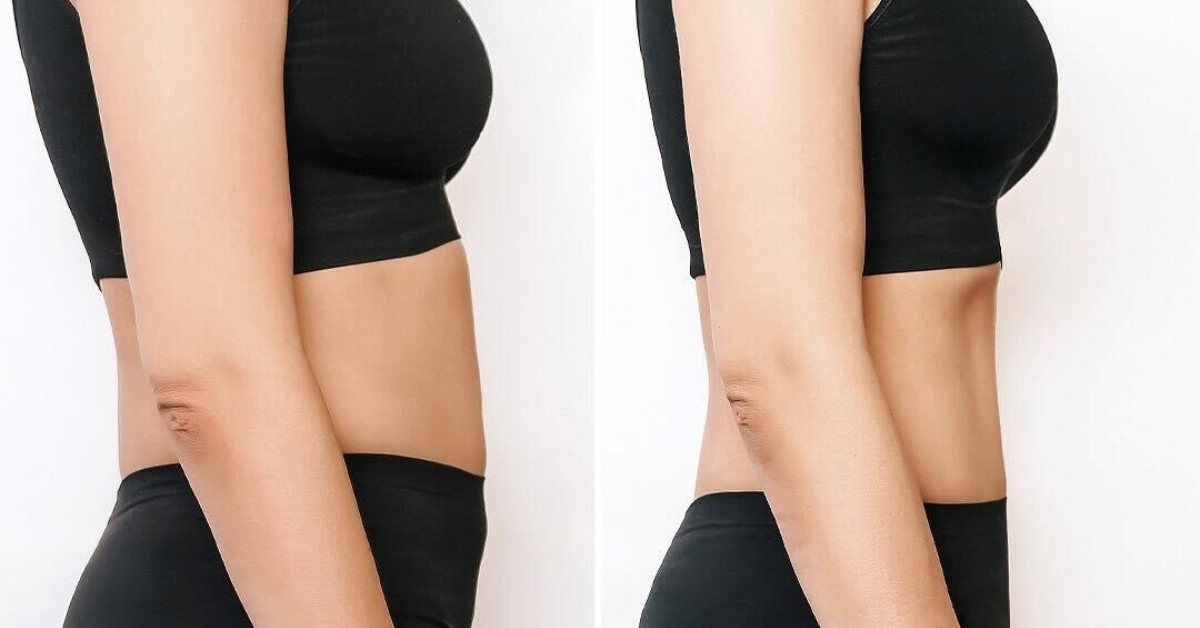 Liposuction for Stubborn Fat Removal: Benefits and Myths Explained