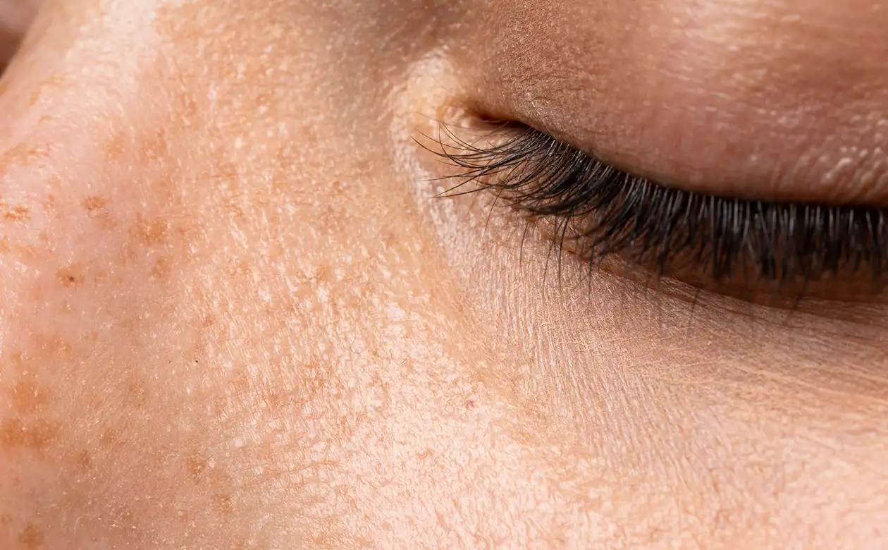 Milia Removal