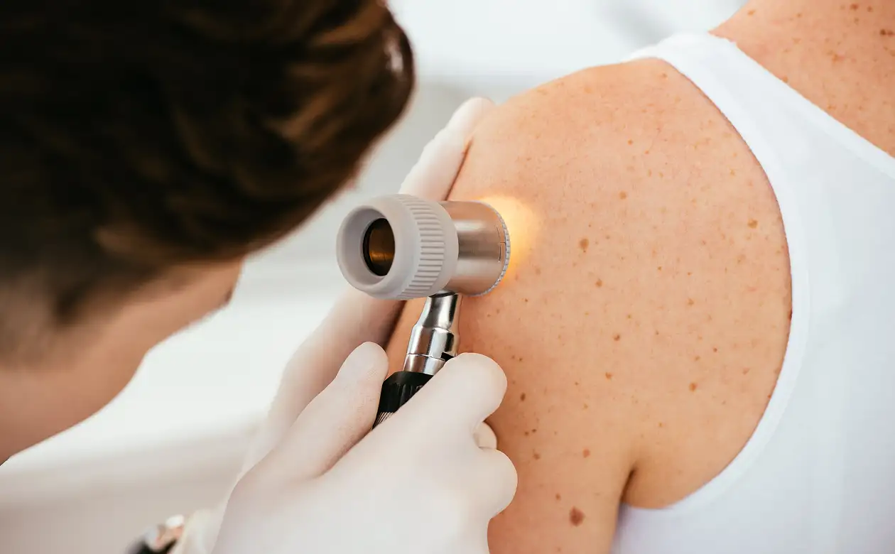 Sub Keratosis (Sun Spots Removal)