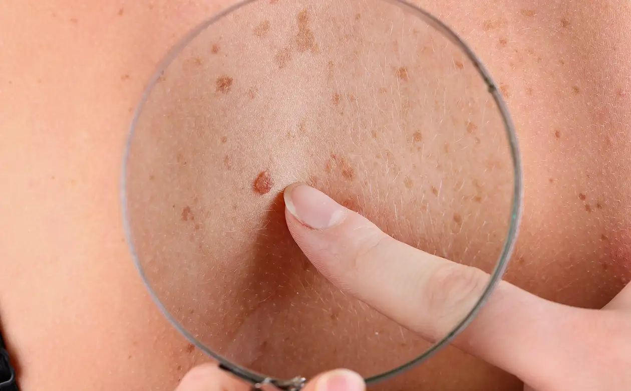 Sebaceous Removal