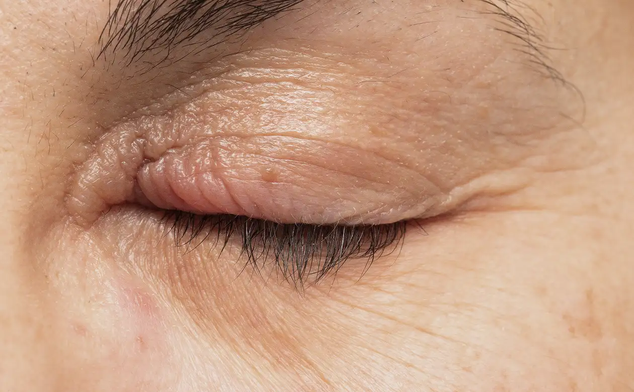 Xanthelasma Removal