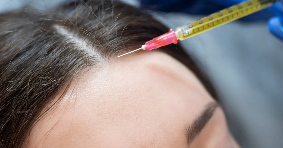 PRF vs PRP: Which One Is Right for Your Hair and Skin?
