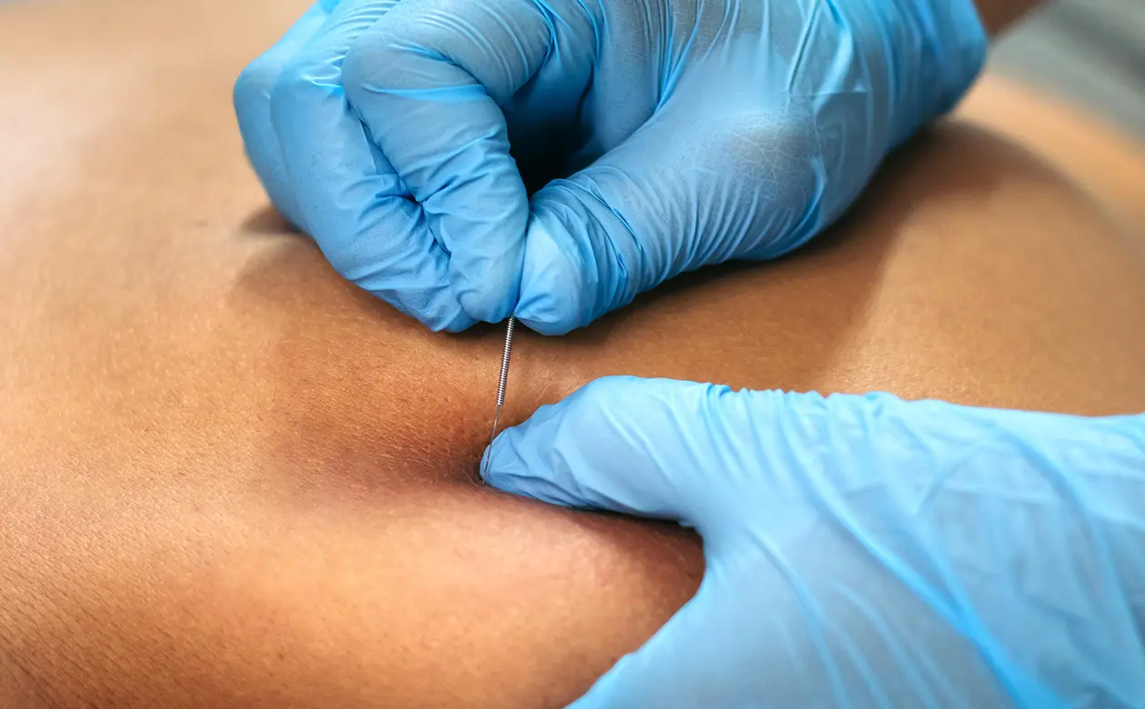 Dry Needling