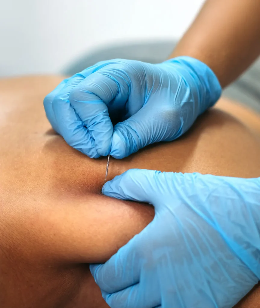 dry-needling