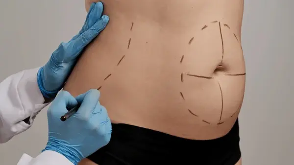 liposuction treatment by surgeon