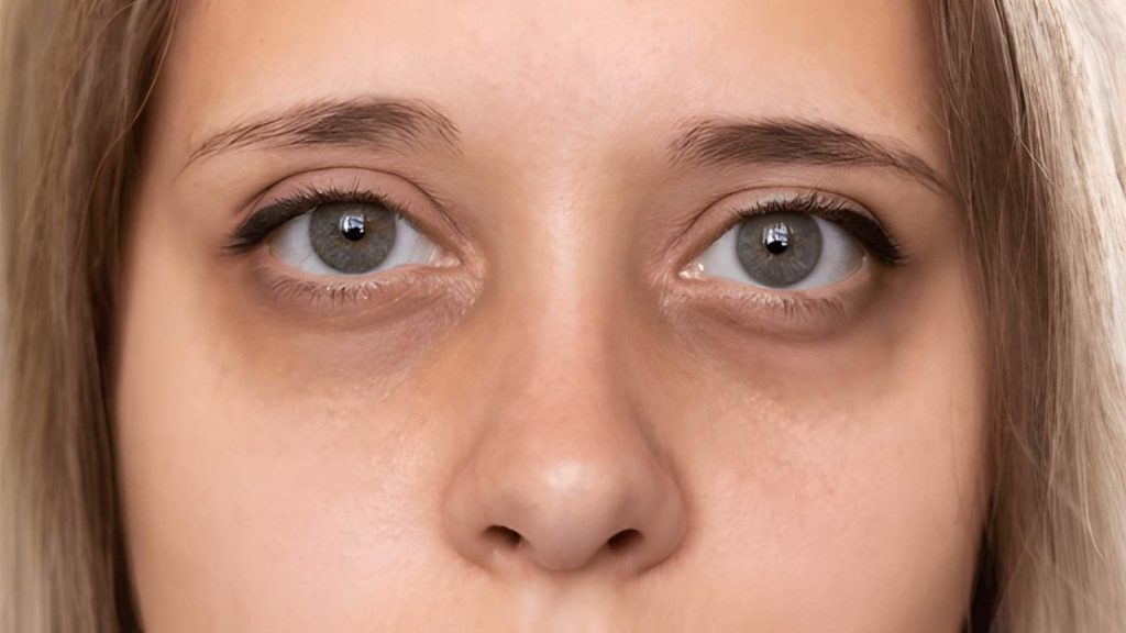 Dark Circles Aren’t Just About Sleep